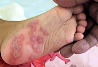 Bệnh tay chân miệng vào mùa: Những điều cần biết