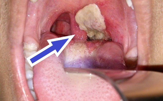benh-bach-hau Bệnh nhân bạch hầu sẽ có giả mạc ở vùng hầu họng màu xám, rất dai, rất khó bóc tách ra khỏi niêm mạc.