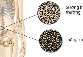 Top 4 loại thực phẩm là “Vua ăn cắp canxi”, khiến nhiều người ngã nhẹ đã gãy xương