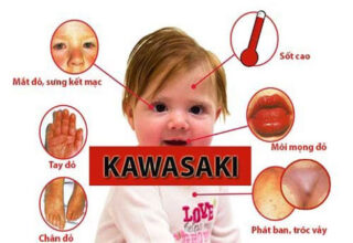Bệnh Kawasaki: Nguyên nhân, triệu chứng và cách điều trị
