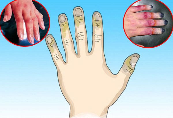 Người bị bỏng lạnh cấp độ 2.