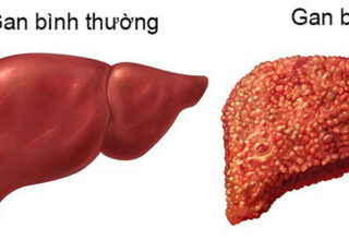 Bệnh xơ gan là gì? Ai dễ bị xơ gan nhất?